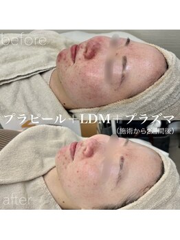 イロハ(IROHA)/プラピール+LDM+プラズマ