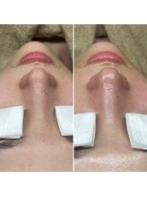 アイスリー(i III)/Before After