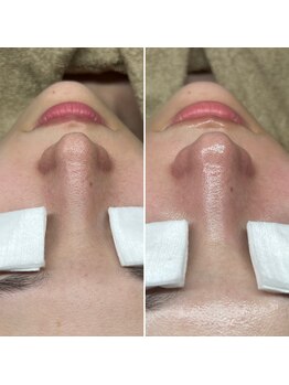 アイスリー(i III)/Before After