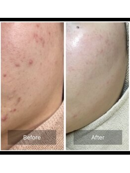 モカ 天王寺店(MOKA)/剥離ハーブピーリングニキビケア