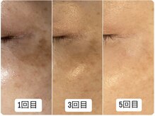 サロン マリー(SALON MARIE)/エステでシミが改善！！