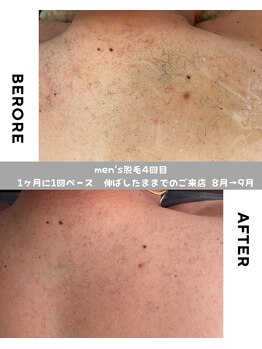 ティエルプラス(tiele+)/全身脱毛4回目/背中