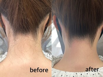 ネイルアンドアイラッシュ アヴィ(Nail and Eyelash A'vi)/ うなじ襟足　光×ワックス脱毛