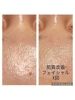 みや美/ドクターリセラ、肌質改善ふぇか