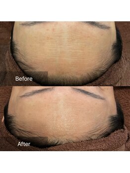 ハピエスト 田辺店/水光肌ピーリング