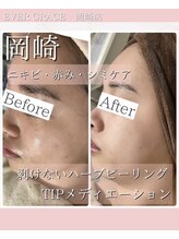 リラベル(Lira Belle)/TIPパール肌トリートメント