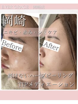 リラベル(Lira Belle)/TIPパール肌トリートメント