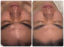 ベルドア(Bell Door)/ハーバルピーリング