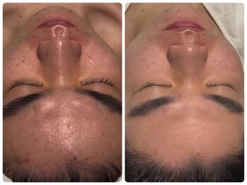 ベルドア(Bell Door)/ハーバルピーリング