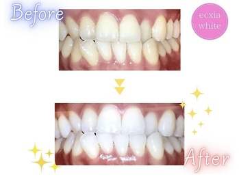 エクシアホワイトニング エミフルMASAKI店/ホワイトニングビフォーアフター