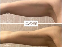 スマイルビューティラボ 別府店(Smile Beauty lab.)/レモンボトル痩身☆