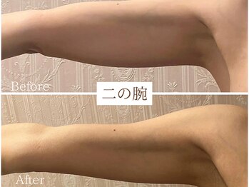 スマイルビューティラボ 別府店(Smile Beauty lab.)/レモンボトル痩身☆