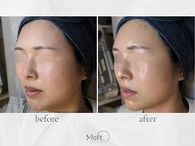 メルト 中目黒(Melt.)/◇ララピール×エレクトロ導入