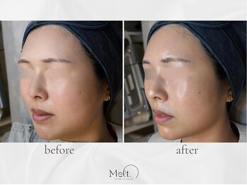 メルト 中目黒(Melt.)/◇ララピール×エレクトロ導入