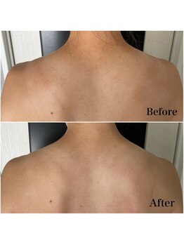 リブ(Lib)/うっかり日焼けケアにも♪