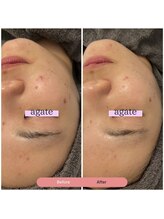 アガットバイミヤモト(agate by miyamoto)/施術3回　約1ヶ月半　1枚目