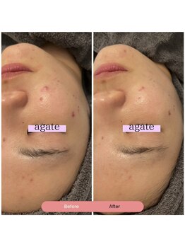 アガットバイミヤモト(agate by miyamoto)/施術3回　約1ヶ月半　1枚目
