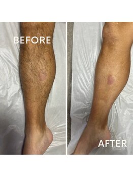 フォーグッド(forgood)/【男性】全身脱毛