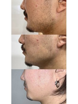 イエナ(IENA)/メンズ人気NO.1美肌ヒゲ脱毛♪