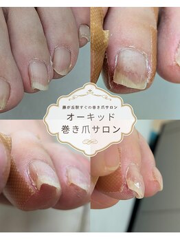 オーキッドの写真/巻き爪・深爪・変形爪のお悩み解決！熟練スタッフが丁寧にケア◎体に優しい施術で理想の指先へ♪