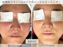 フラリ 西葛西(Hulali)/【40代】マイクロニードル6回目