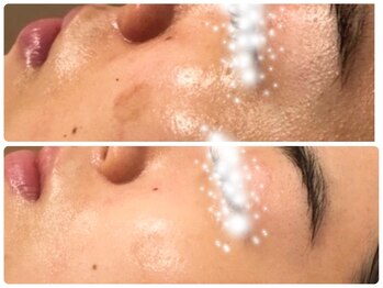 レ ベージュ(L’Beige)/リアボーテ肌質改善フェイシャル