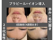 イーラボ 池袋店(e-LABO)/韓国肌管理/プラピール