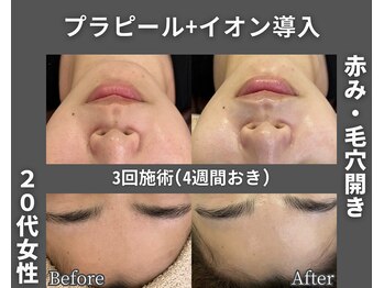 イーラボ 池袋店(e-LABO)/韓国肌管理/プラピール