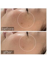 ペルラペティーユ(PERLA PETILLER)/ビタミンC,A導入