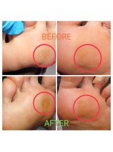 アンティ(Aunty)/足裏のタコ