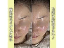 ハニエル(Haniel)/カーボキシー症例