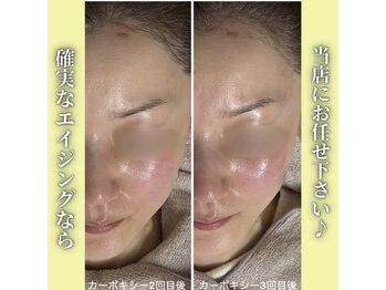 ハニエル(Haniel)/カーボキシー症例