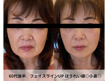 トータルビューティーサロンリア(Li'a)の写真/【倉敷希少の最新小顔マシーン★】切らないたるみ改善でスッキリしたフェイスラインに！施術後に効果実感◎