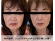 トータルビューティーサロンリア(Li'a)の写真/【倉敷希少の最新小顔マシーン★】切らないたるみ改善でスッキリしたフェイスラインに！施術後に効果実感◎