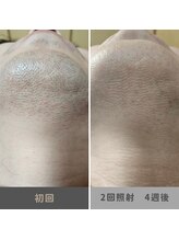 キムラケ 和光別邸(木村家 KIMURAKE)/メンズ脱毛ヒゲビフォーアフター