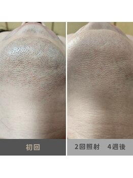 キムラケ 和光別邸(木村家 KIMURAKE)/メンズ脱毛ヒゲビフォーアフター