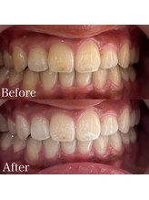 ホワイトニングカフェ 吉祥寺店(WhiteningCafe)/8回コース / ビフォーアフター