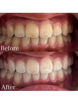 ホワイトニングカフェ 吉祥寺店(WhiteningCafe)/8回コース / ビフォーアフター