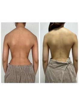 オンケイ(Onkei)/インディバお背中