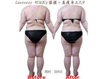 ラエッセス(A Laessess)/ゼロポジ筋膜＋美痩身エステ