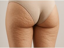 サロンココ(salon koko)の雰囲気（出来てしまったセルライトにはこだわり器械×凄技ハンドで撃退！）