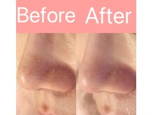 リンダ 西宮店(LINDA)/毛穴改善スペシャル