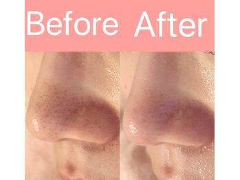 リンダ 西宮店(LINDA)/毛穴改善スペシャル