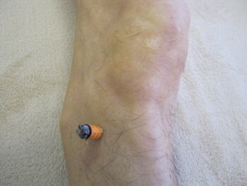 群馬藤岡はりきゅう整体院/お灸