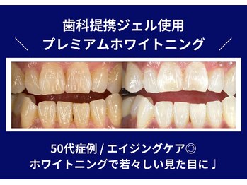 ホワイトニングカフェ 本厚木店/◎歯のホワイトニング施術写真◎