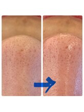 ブルームーン(Blue Moon)/毛穴洗浄　ビフォーアフター