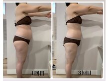 ハル(Haru)/施術前後写真