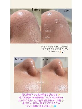 クレヴィー(Creviy)/3D毛穴洗浄×ハーブピーリング