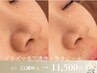 金土日限定★肌管理＆水光肌ララピール×プラズマ毛穴洗浄￥33,000→￥11,500