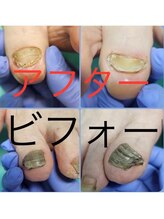 巻き爪補正店 松本店/初回の施術